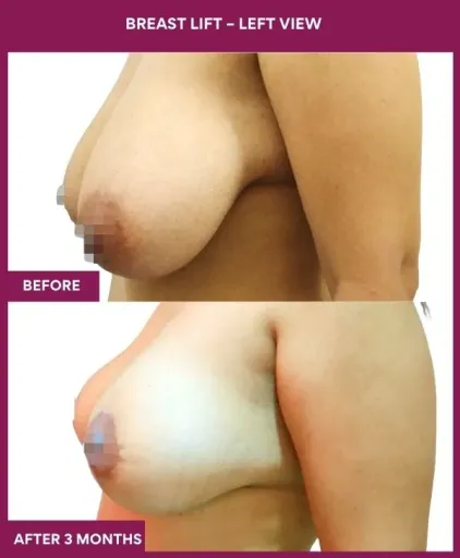 4 Breast Lift – Left View_11
