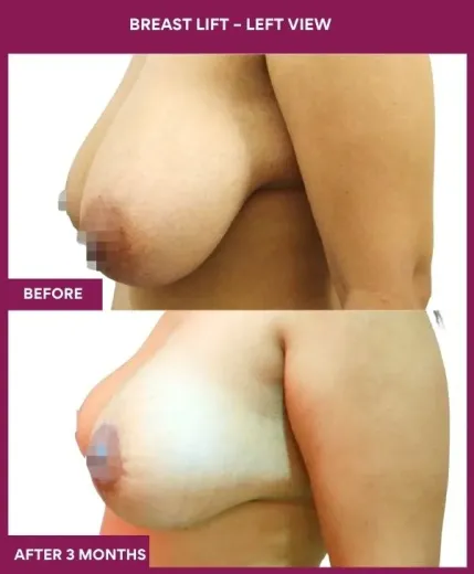 4 Breast Lift – Left View_11