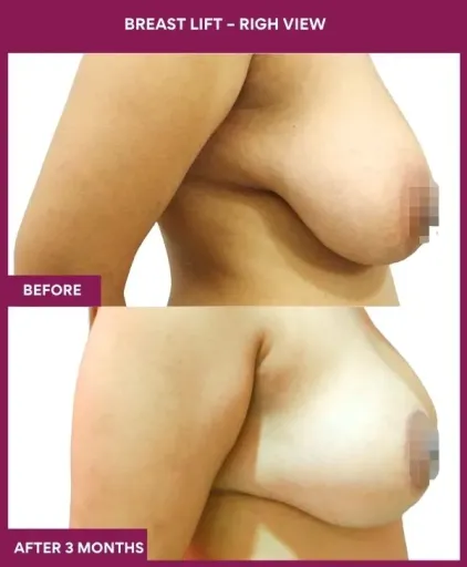 4 Breast Lift – righ View_12