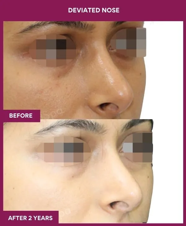 4 DEVIATED NOSE (3)_29_