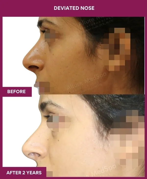 4 DEVIATED NOSE (4)_29_