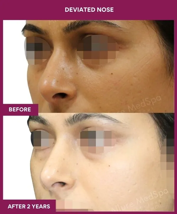 4 DEVIATED NOSE (5)_29_