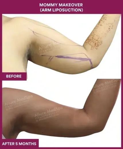 4 Mommy Makeover (Arm Liposuction) (3)