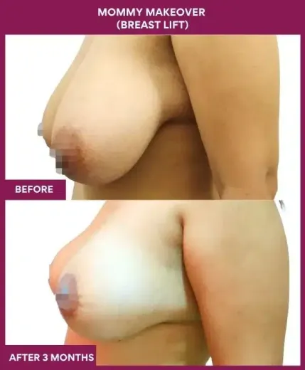 4 Mommy Makeover (BREAST LIFT)_46 (3)