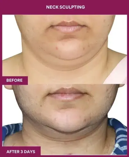 NECK SCULPTING in Mumbai, India