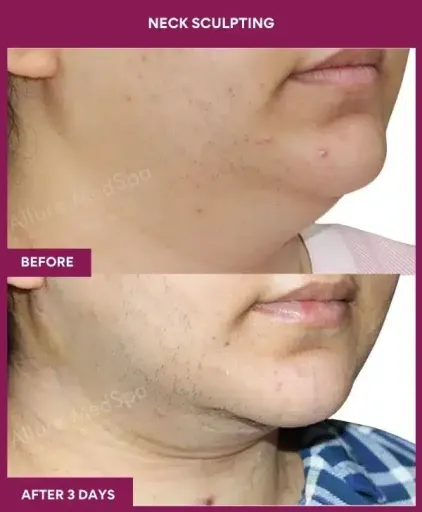 NECK SCULPTING in Mumbai, India