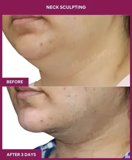 NECK SCULPTING in Mumbai, India