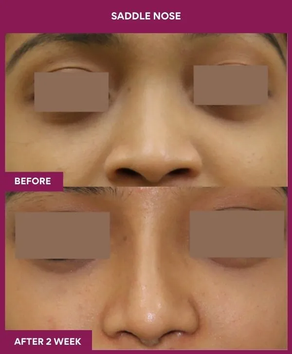 4 SADDLE NOSE_59_ (1)