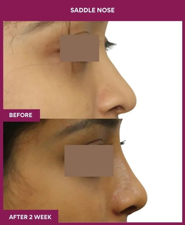 4 SADDLE NOSE_59_ (2)