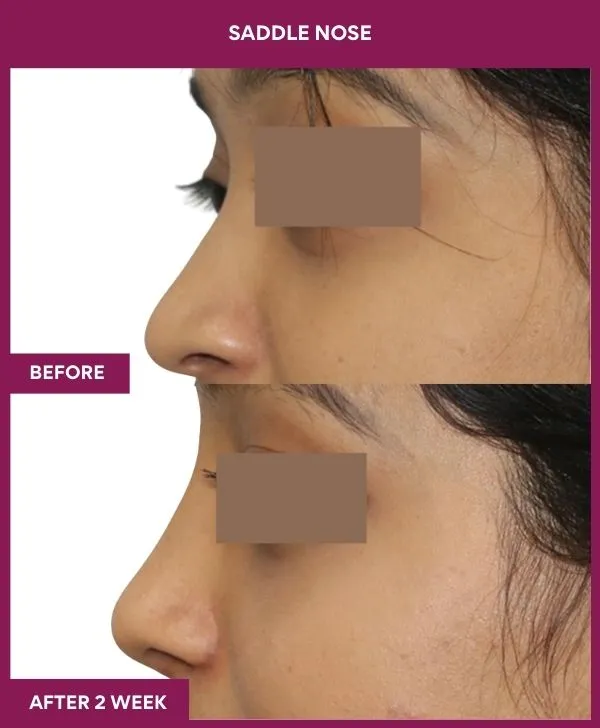 4 SADDLE NOSE_59_ (3)