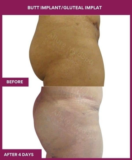 5 BUTT IMPLANT_GLUTEAL IMPLAT in Mumbai, India