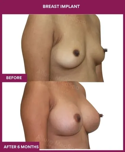 5 Breast implant_14_ (2)