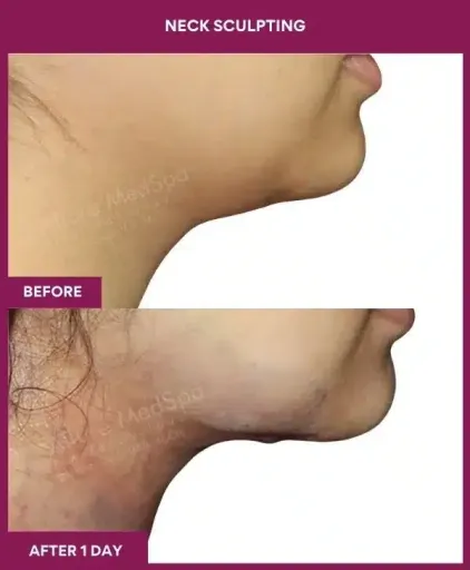 Female NECK SCULPTING in Mumbai, India
