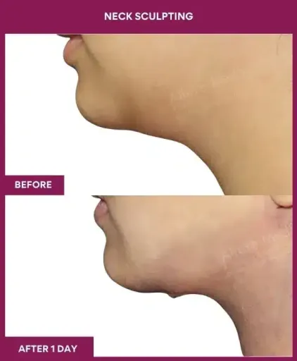 Female NECK SCULPTING in Mumbai, India