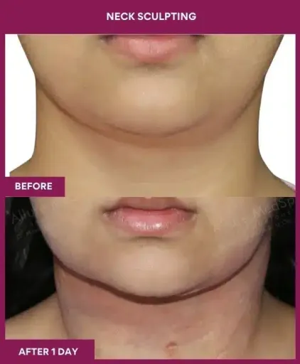 Female NECK SCULPTING in Mumbai, India