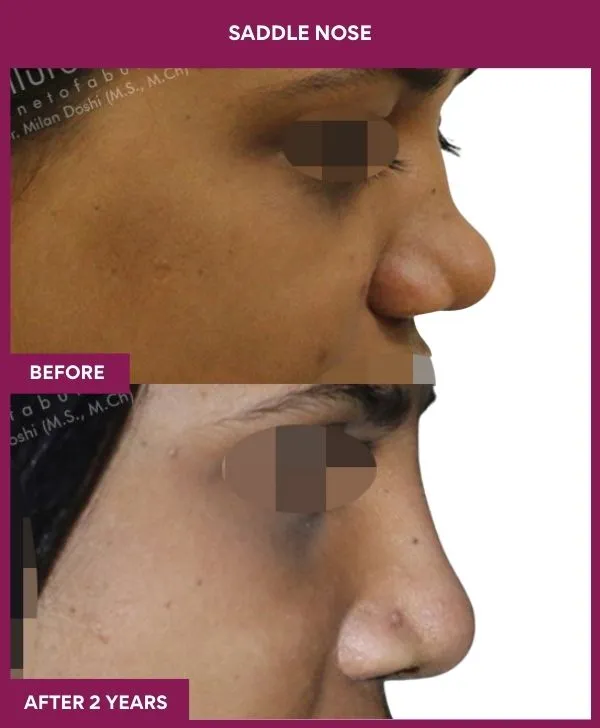 5 SADDLE NOSE (3)_61_