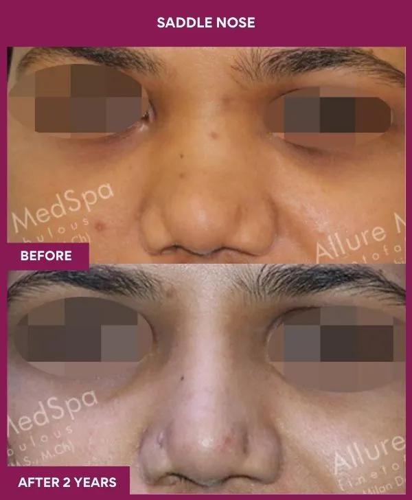 5 SADDLE NOSE (4)_61_