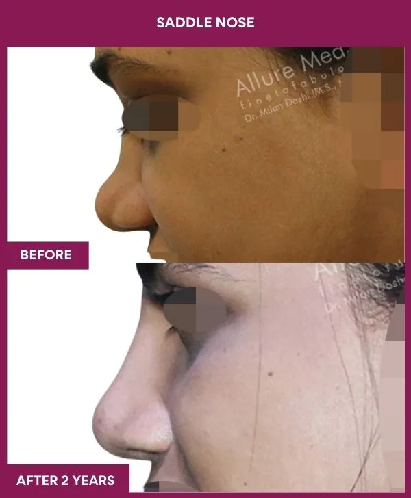 5 SADDLE NOSE (5)_61_