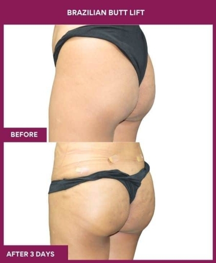 6 Brazilian Butt Lift (3) in Mumbai, India
