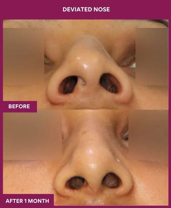 6 DEVIATED NOSE (2)_32_