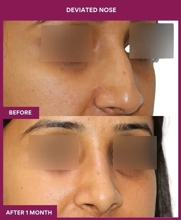 6 DEVIATED NOSE (3)_32_