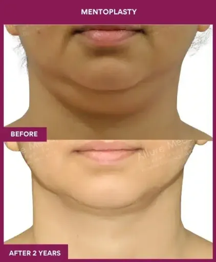 MENTOPLASTY in Mumbai, India