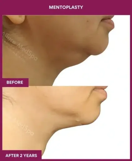 MENTOPLASTY in Mumbai, India