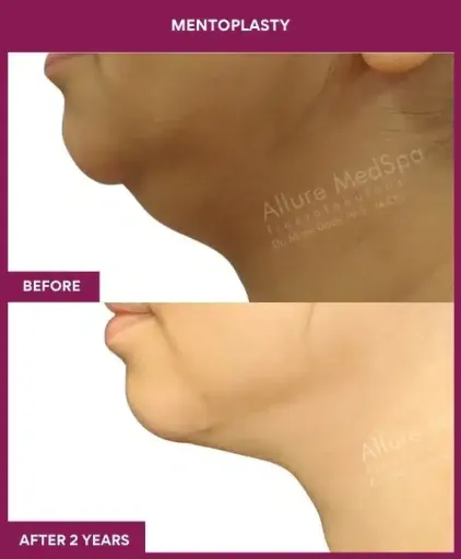 MENTOPLASTY in Mumbai, India