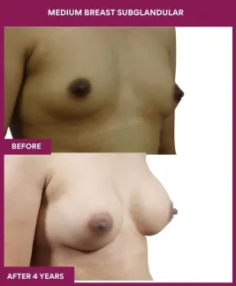 6 Medium breast subglandular (2)_15_