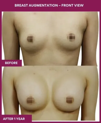 7 Breast Augmentation – Front View_18