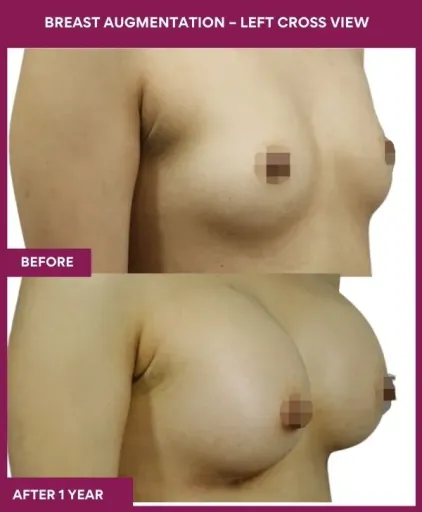 7 Breast Augmentation – Right Cross View (2)_19