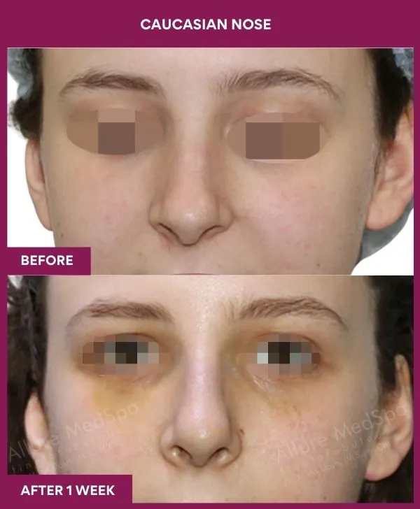 7 Caucasian nose_25_ (1)