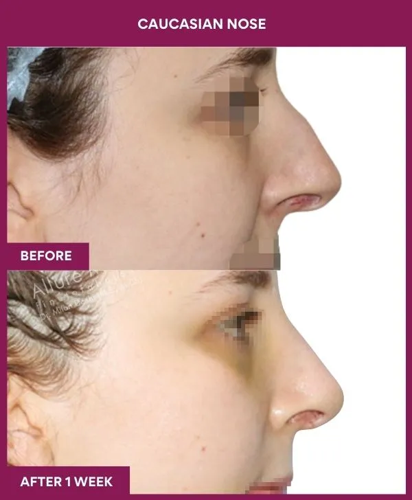 7 Caucasian nose_25_ (2)