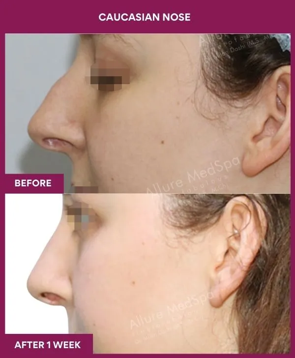 7 Caucasian nose_25_ (3)