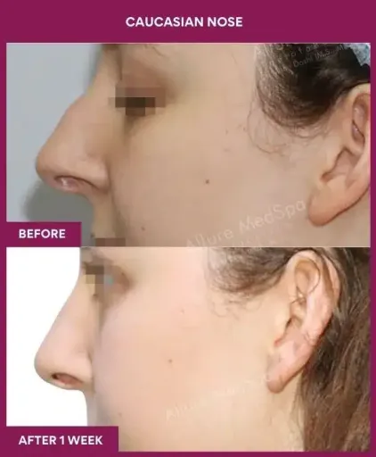 7 Caucasian nose_25 in Mumbai, India