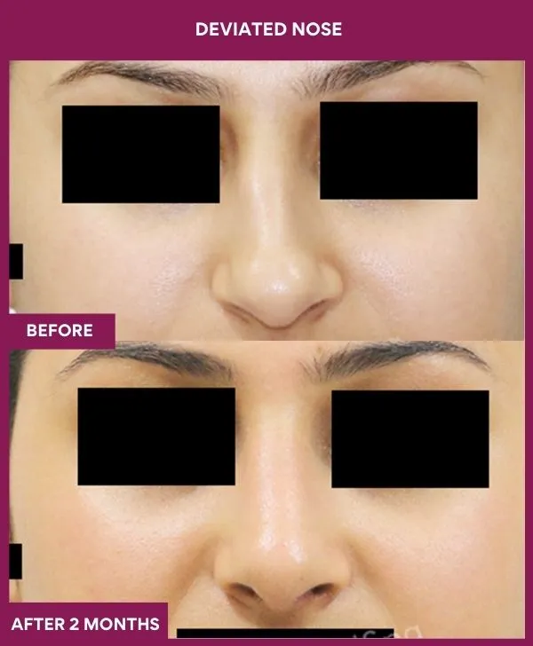 7 DEVIATED NOSE_36_ (1)