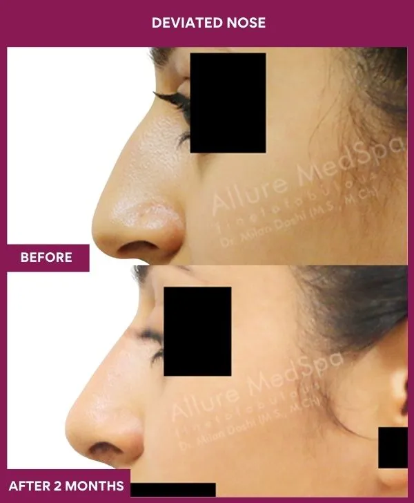 7 DEVIATED NOSE_36_ (2)