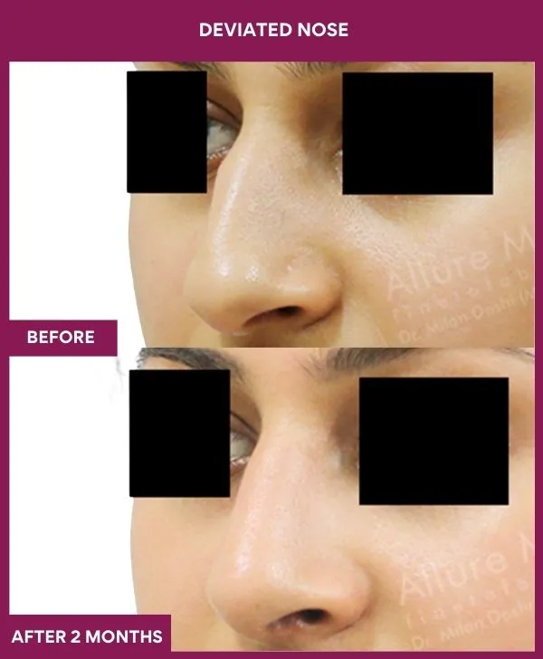 7 DEVIATED NOSE_36_ (3)