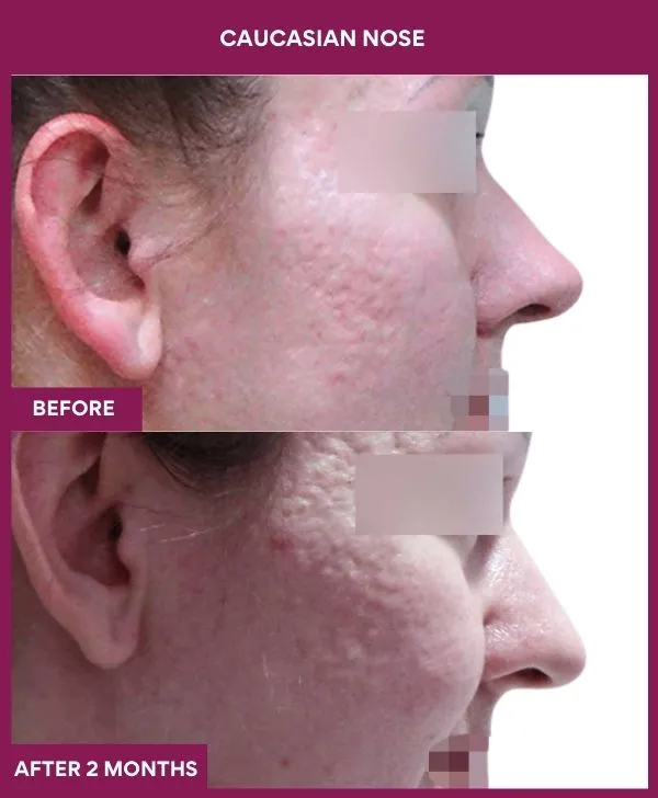 8 Caucasian nose (3)_27_