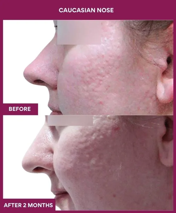 8 Caucasian nose (4)_27_