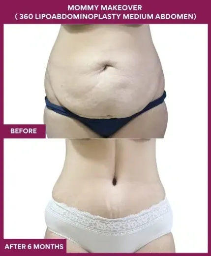 9 Mommy Makeover ( 360 LIPOABDOMINOPLASTY MEDIUM ABDOMEN) (4)_132