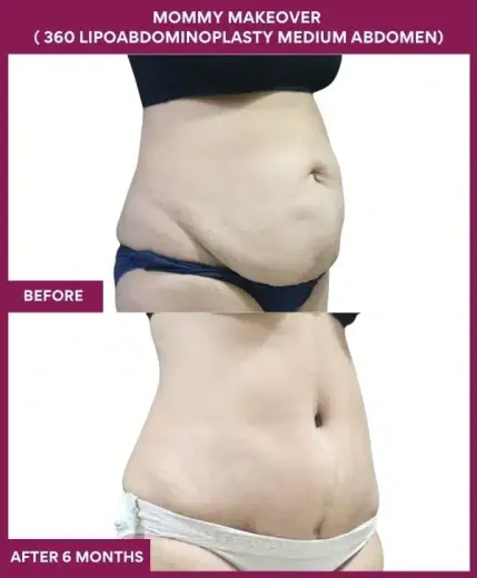 9 Mommy Makeover ( 360 LIPOABDOMINOPLASTY MEDIUM ABDOMEN) (5)_132