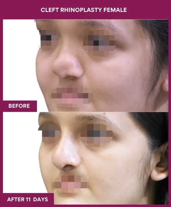 9 cleft rhinoplasty female_31_ (3)