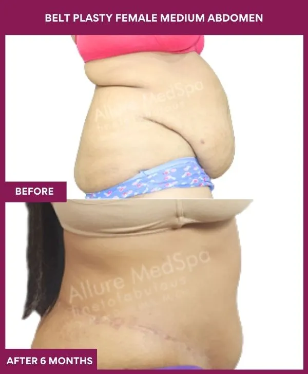 1 BELT PLASTY FEMALE MEDIUM ABDOMEn (3)_2_