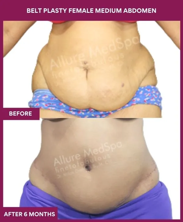 1 BELT PLASTY FEMALE MEDIUM ABDOMEn (4)_2_