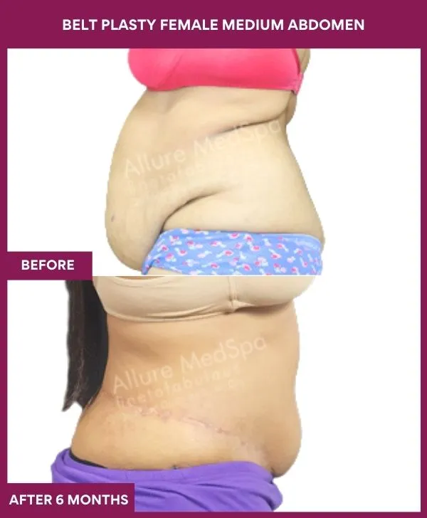 1 BELT PLASTY FEMALE MEDIUM ABDOMEn (5)_2_