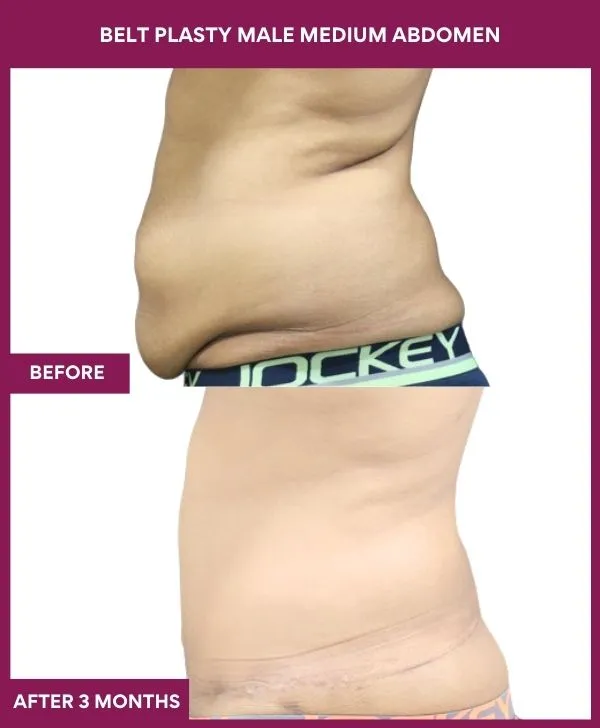 1 BELT PLASTY MALE MEDIUM ABDOMEn (3)_5_