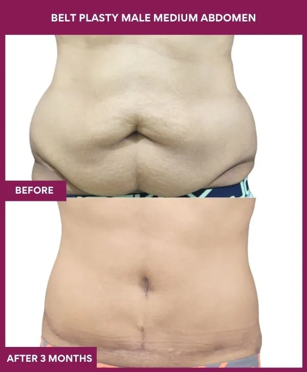 1 BELT PLASTY MALE MEDIUM ABDOMEn (4)_5_