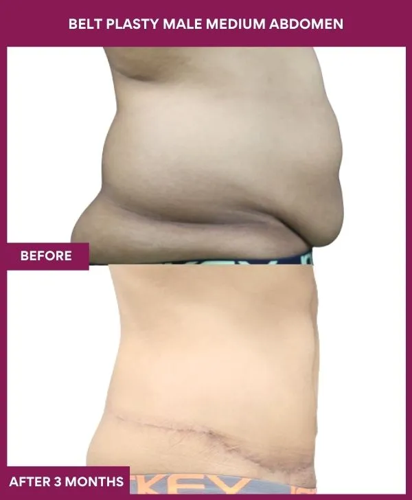 1 BELT PLASTY MALE MEDIUM ABDOMEn (5)_5_