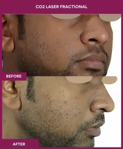 1 CO2 Laser Fractional (2)